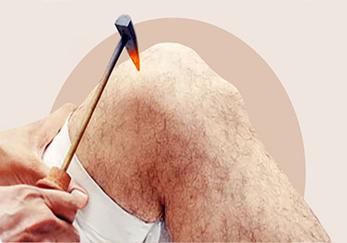 Agnikarma (Therapeutic Cautery)
