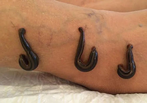 Jalaukavacharana( Leech Therapy )
