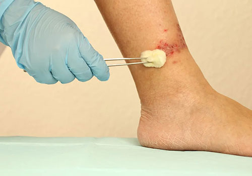Chronic Wound / Ulcer