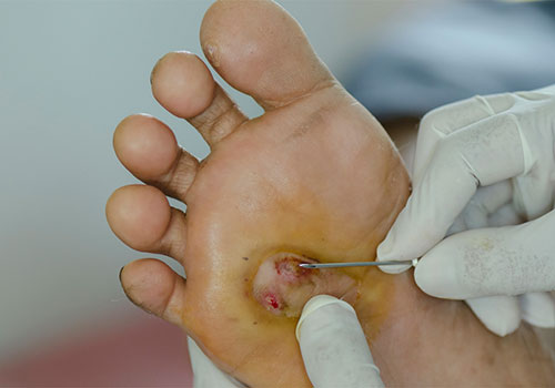 Diabetic Wound